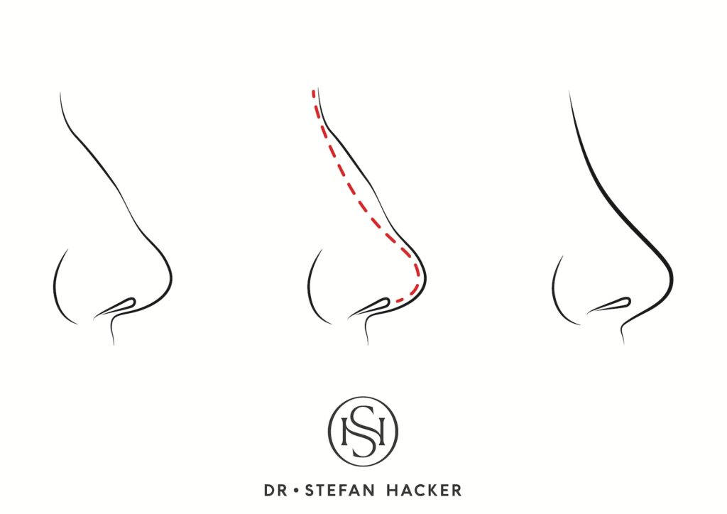 Infografik-Nasenkorrektur-Technik-Dr-Hacker