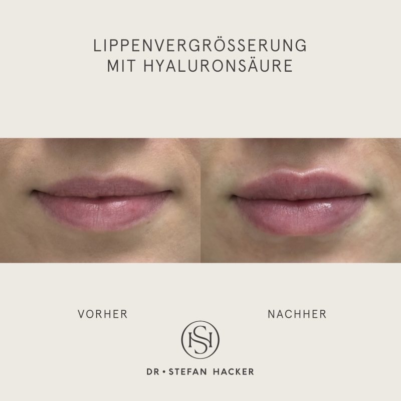 lippen-aufspritzen-1ml-vorher-nachher