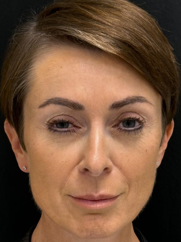 01_Botox_nachher