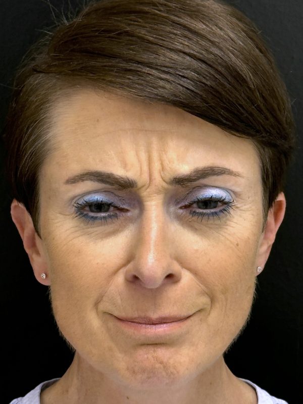 01_Botox_vorher