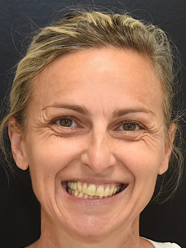02_Botox_vorher