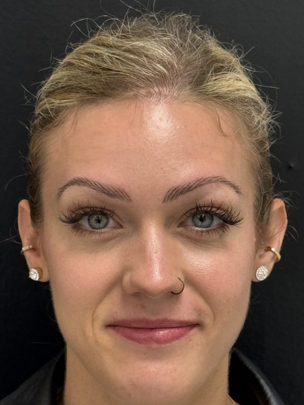 04_Botox_nachher