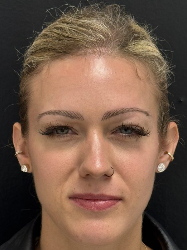 05_Botox_nachher