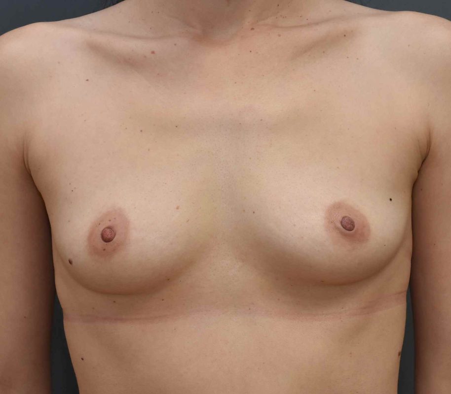 3_Brustvergrößerung_mit_Implantat_vorher