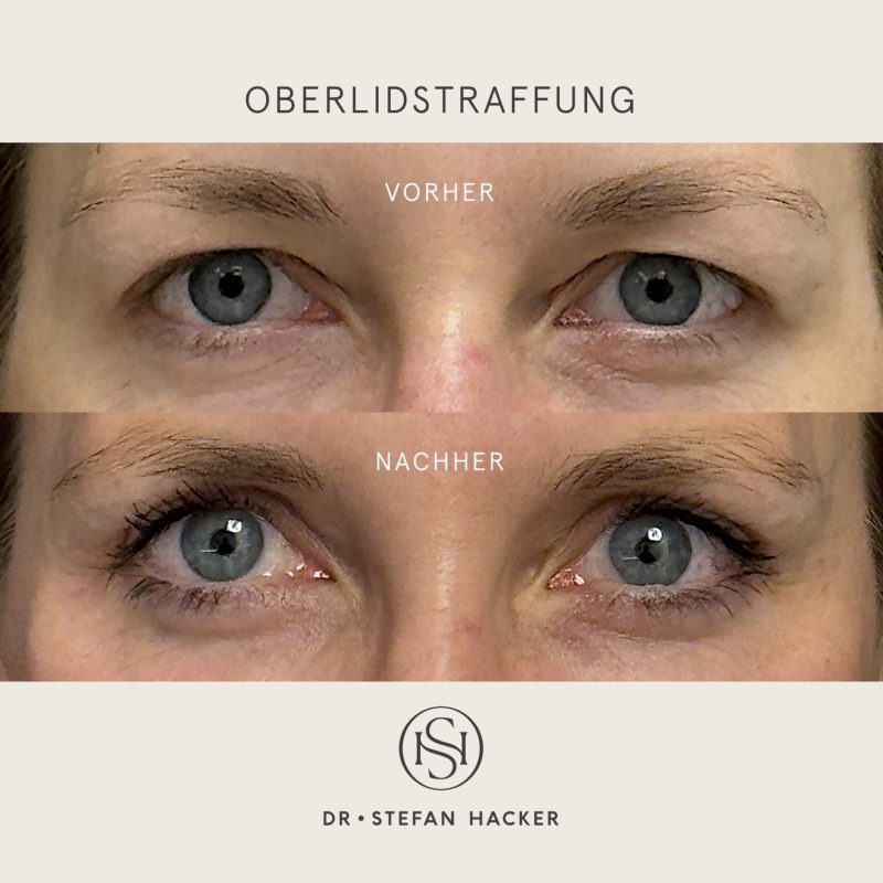 oberlidstraffung_vorher_nachher_1
