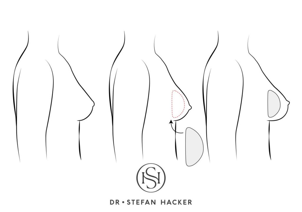 infografik_brustvergroesserung_implantate_technik_dr_stefan_hacker