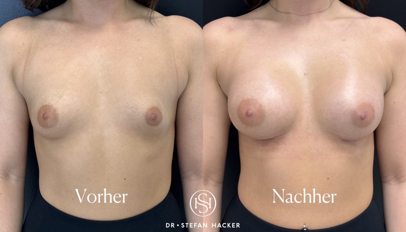 brustvergroesserung_vorher_nachher_295cc