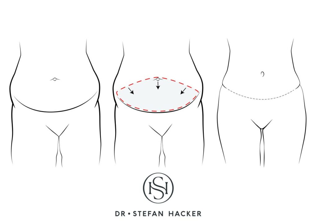infografik_bauchstraffung_mommy_makeover_technik_dr_stefan_hacker