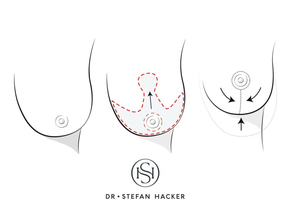 infografik_bruststraffung_mommy_makeover_technik_dr_stefan_hacker
