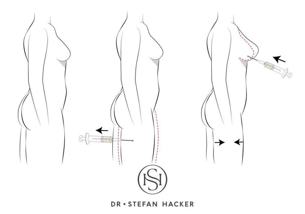 infografik_brustvergroesserung_mit_eigenfett_mommy_makeover_technik_dr_stefan_hacker