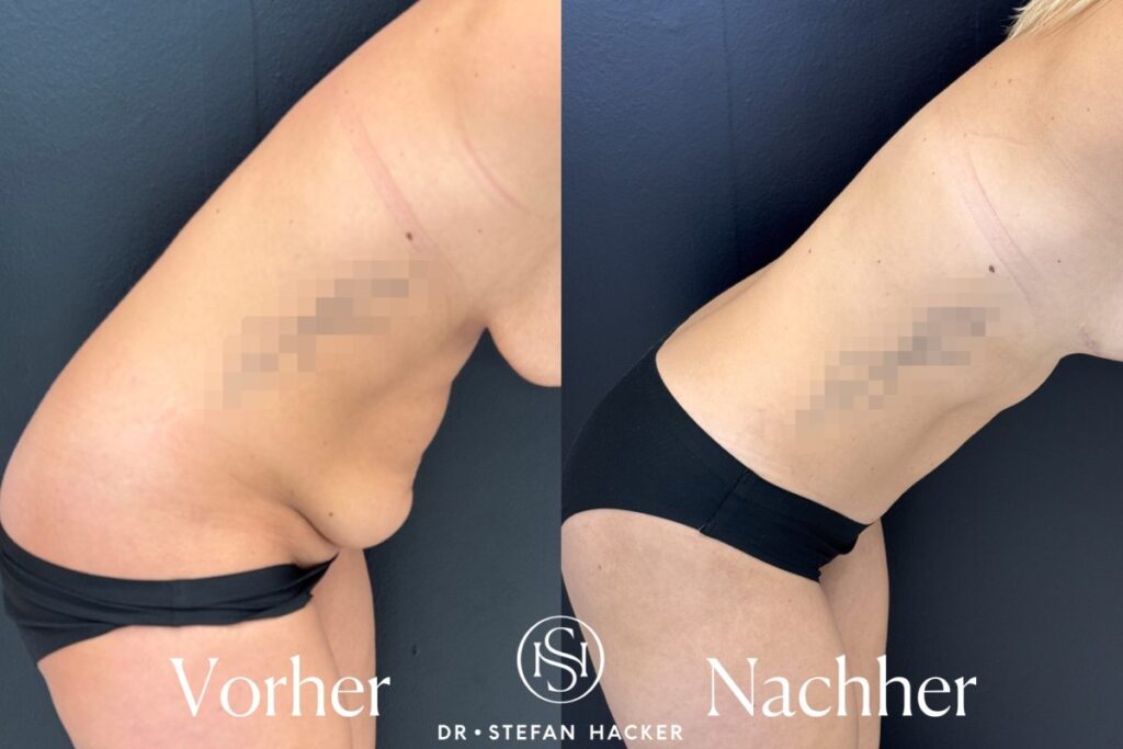 mommy_makeover_fuer_straffen_bauch_vorher_nachher