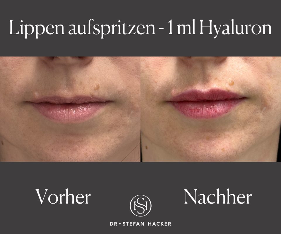 lippen-aufspritzen-1ml-hyaluron-vorher-nachher-dr-stefan-hacker