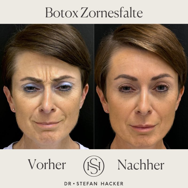 botox-zornesfalte-vorher-nachher-dr-stefan-hacker