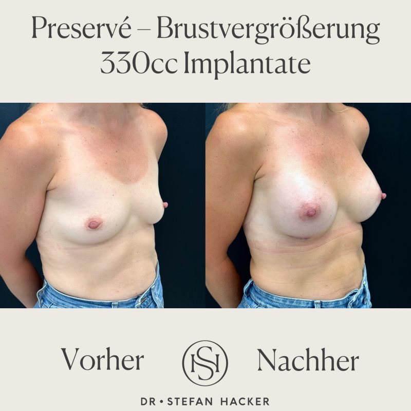 preserve-brustvergroesserung-330cc-vorher-nachher