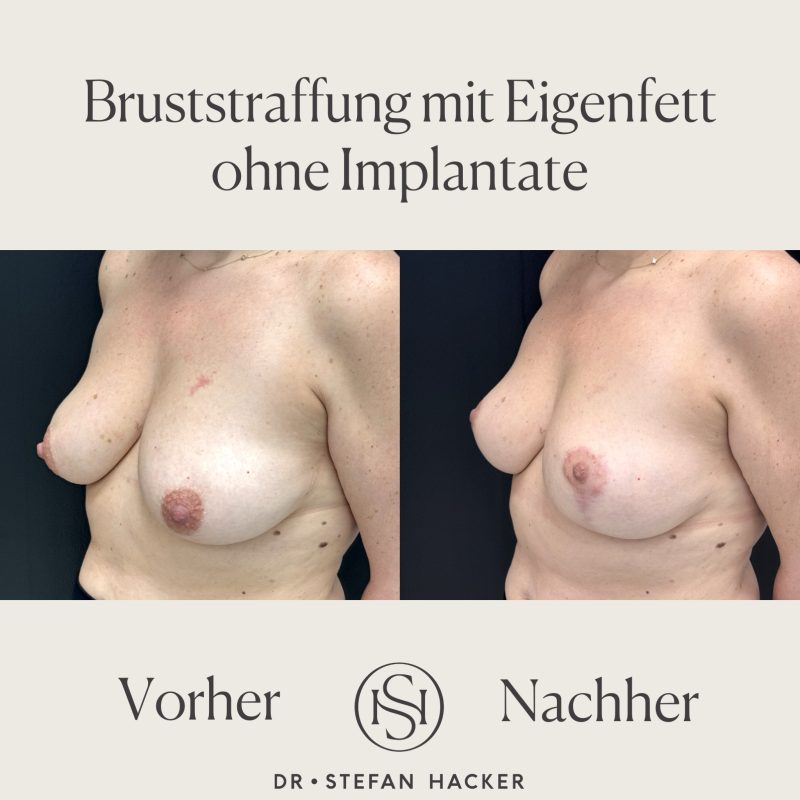bruststraffung-mit-eigenfett-ohne-implantate-dr-stefan-hacker